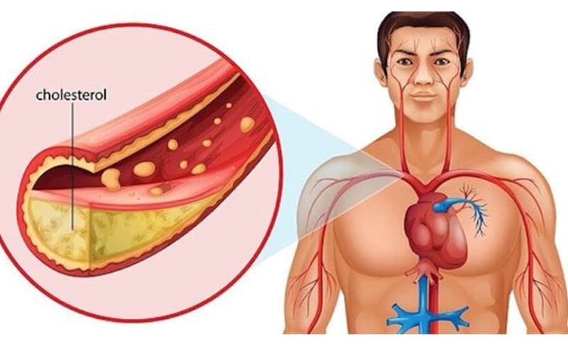 Chỉ định Atorvastatin 20mg