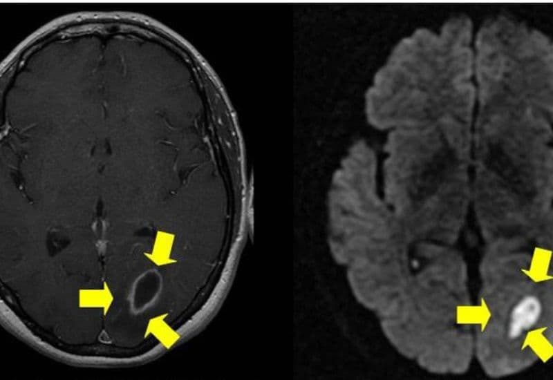 áp xe tai có thể gây viêm màng não