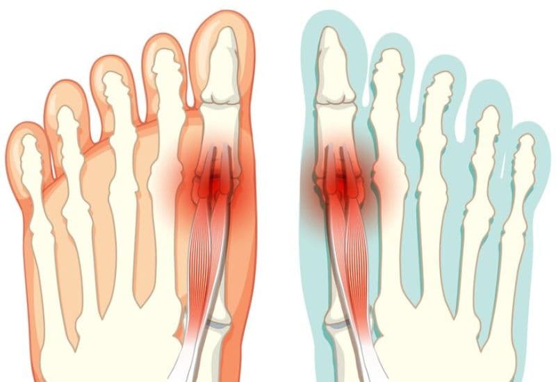 triệu chứng của gãy ngón chân