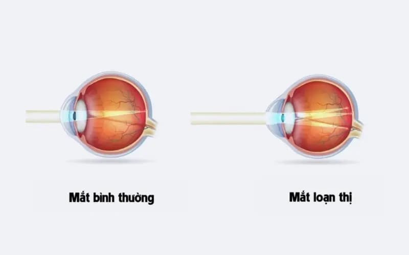 Hình dạng thủy tinh thể không đều dẫn đến loạn thị