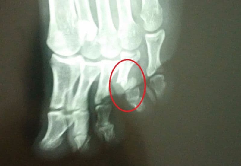 biến chứng khi bị gãy ngón chân