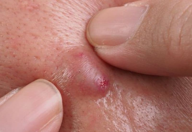 sai lầm khi chữa áp xe ở nhà 