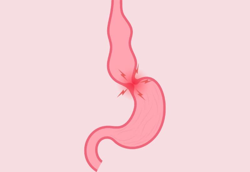 Mối liên hệ giữa nuốt nghẹn về đêm và rối loạn thần kinh thực quản