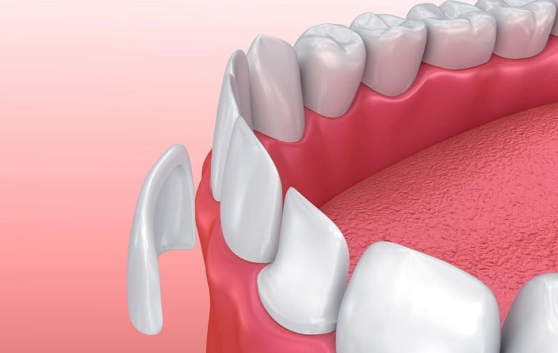 lợi ích của phương pháp dán veneer sứ