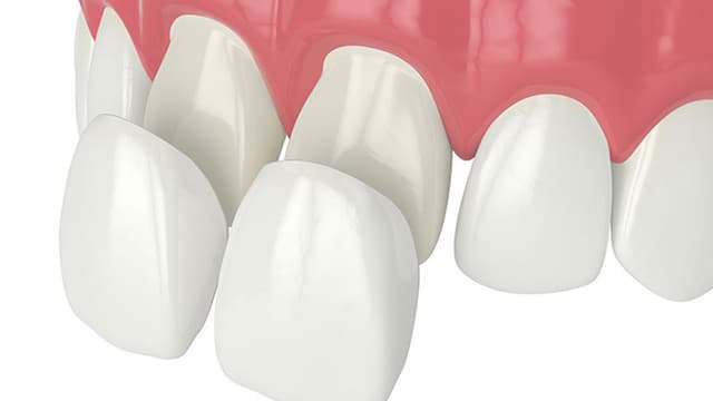 Sự thật dán veneer sứ có mài răng không và chi phí thực hiện