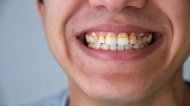 Chi phí làm sứ veneer là bao nhiêu?