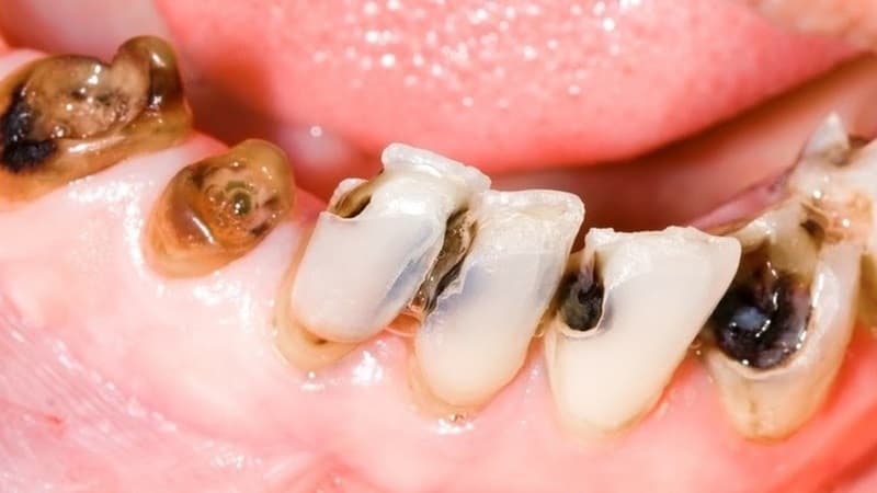 Không phải ai cũng có thể làm răng