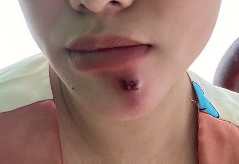 Dấu hiệu nhiễm trùng áp xe 