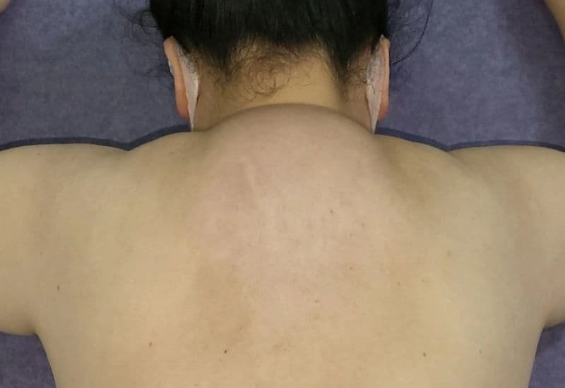 u mỡ ở lưng quá lớn