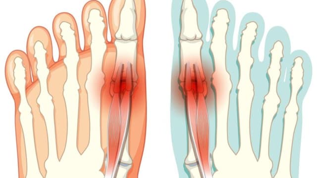 Gãy ngón chân: Nguyên nhân, triệu chứng và cách điều trị hiệu quả