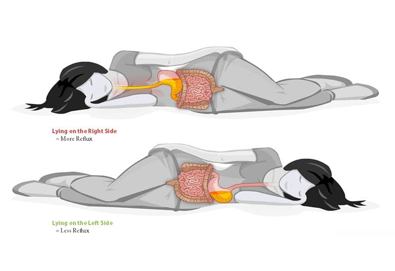 Trào ngược dạ dày thực quản (GERD) gây khó nuốt khi ngủ