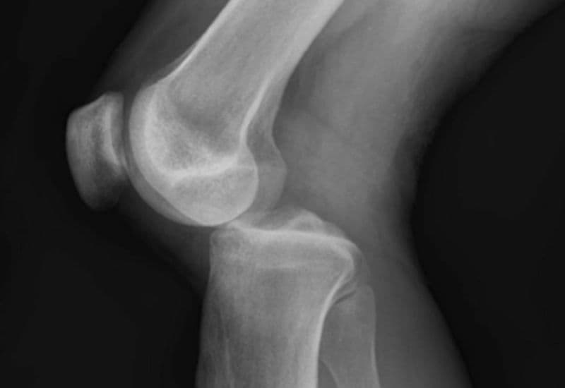 Trật khớp đầu gối 