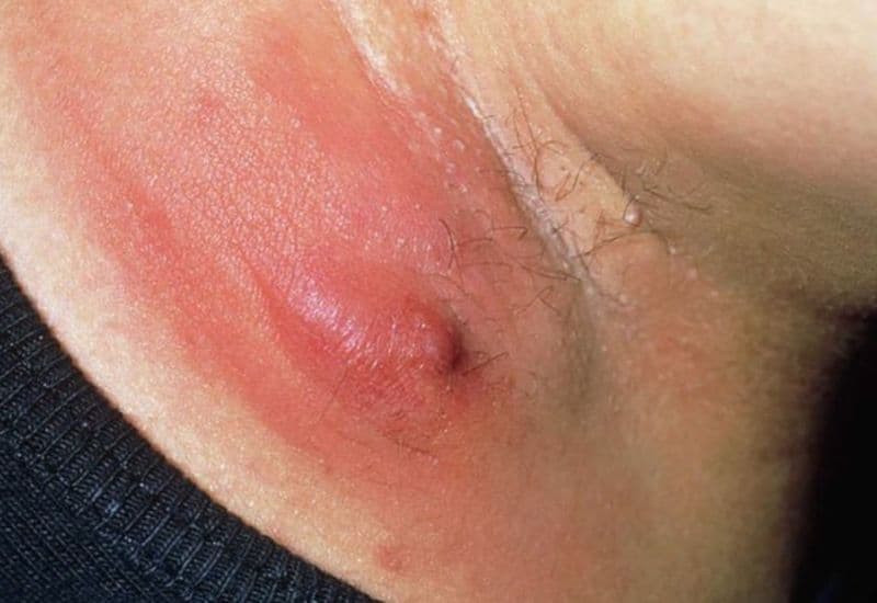 Mổ áp xe ở nách 