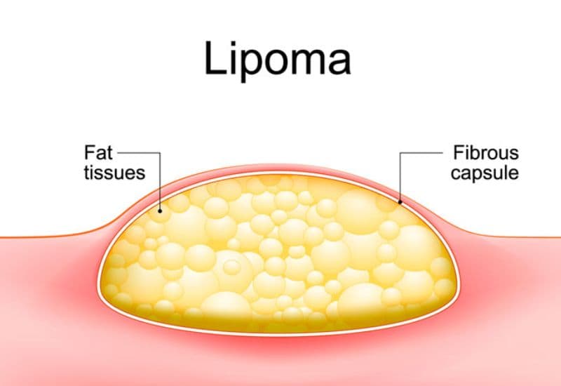 mô tả u mỡ sau gáy