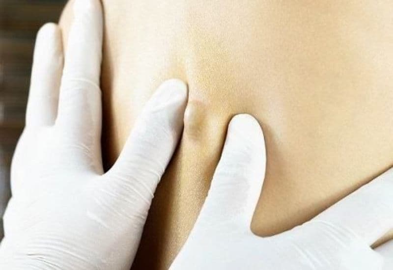 Tự ý nặn mụn u bã đậu 