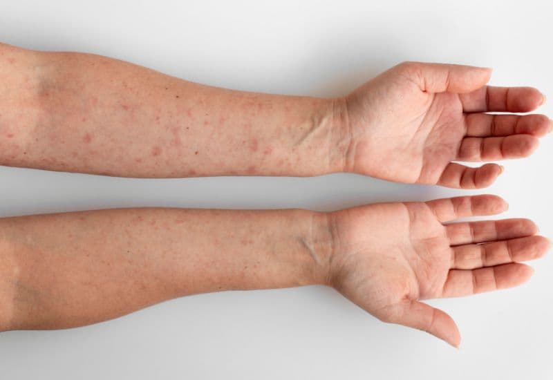 Ngứa sau tiêm vắc-xin là một phản ứng khá phổ biến, nhưng không phải ai cũng hiểu rõ về nó.