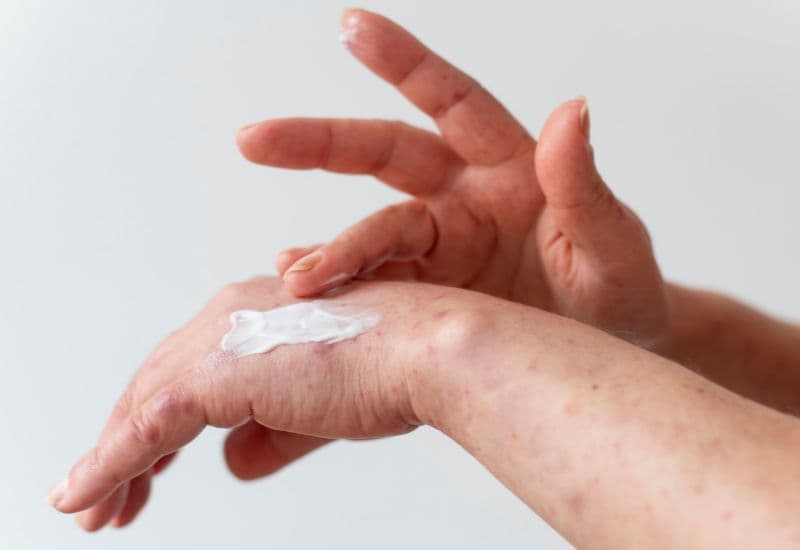 Cách xử lý hiện tượng ngứa sau khi tiêm vắc-xin