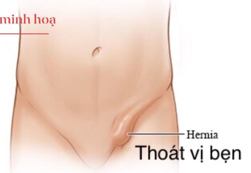 biểu hiện thoát vị bẹn