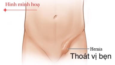 Nhận diện sớm các biểu hiện thoát vị bẹn
