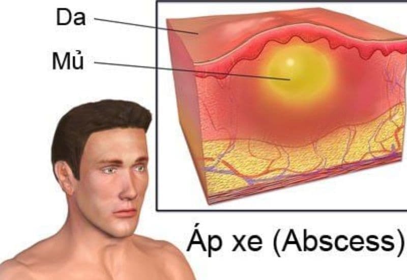 nhiễm trùng áp xe