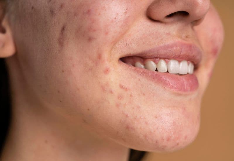 Tiêm vắc-xin và sự xuất hiện của mụn có thể có mối liên hệ, nhưng điều này không phải lúc nào cũng xảy ra với tất cả mọi người.