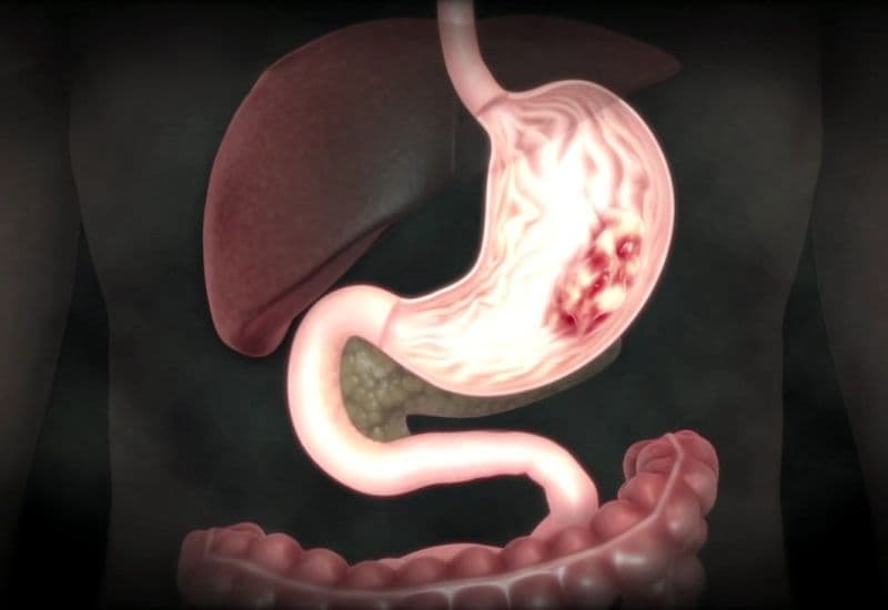 Ợ hơi nóng bụng có gây nguy hiểm