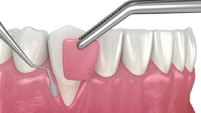 Chi tiết về chi phí phẫu thuật ghép lợi hết bao nhiêu tiền