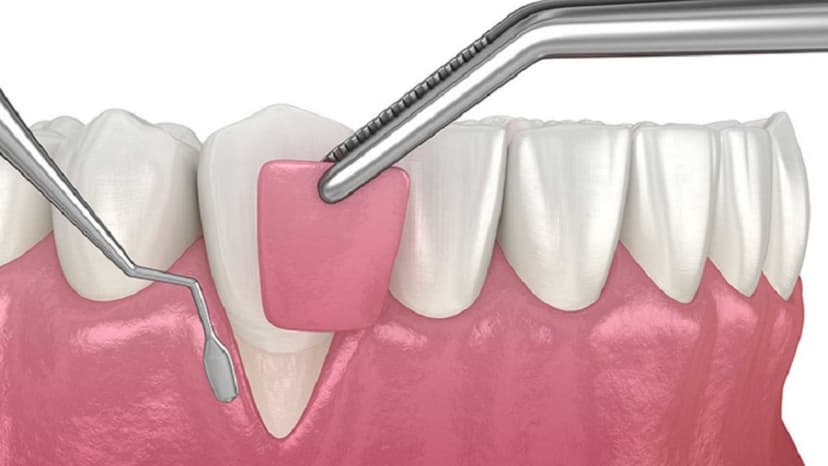 Chi tiết về chi phí phẫu thuật ghép lợi hết bao nhiêu tiền