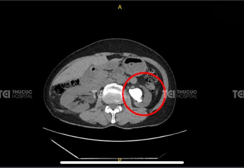 Sỏi san hô không nhất thiết phải mổ mở