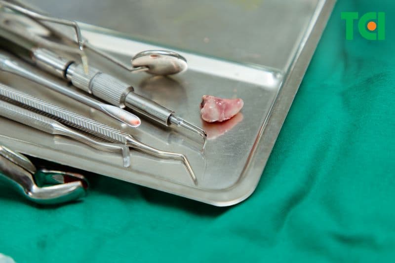 sưng nướu trong cùng hàm dưới