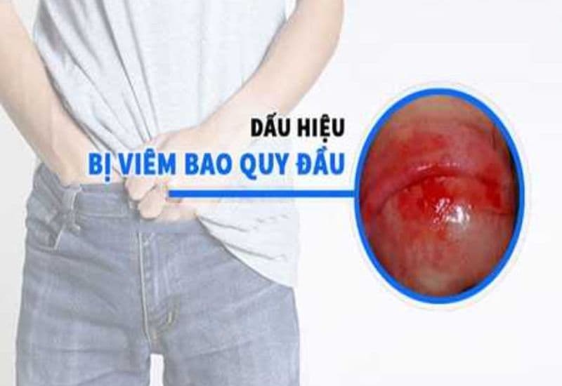 Triệu chứng hẹp bao quy đầu và biến chứng 