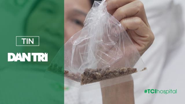 Sỏi san hô 5.5cm được loại sạch nhờ kỹ thuật tán sỏi hiện đại, không mổ mở