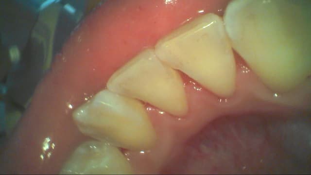 5 Cách tẩy mảng bám răng hiệu quả tại nhà và phòng nha khoa