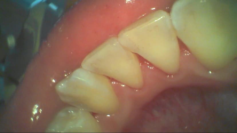5 Cách tẩy mảng bám răng hiệu quả tại nhà và phòng nha khoa