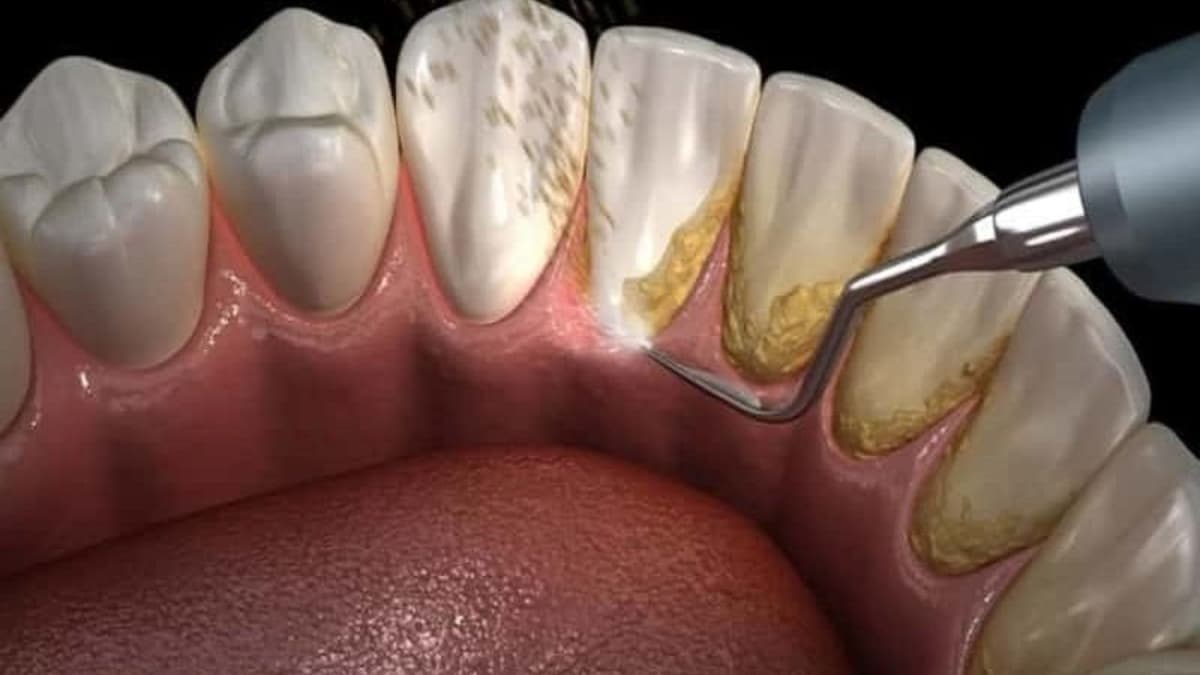 Giải đáp thắc mắc về chi phí tẩy vôi răng bao nhiêu tiền