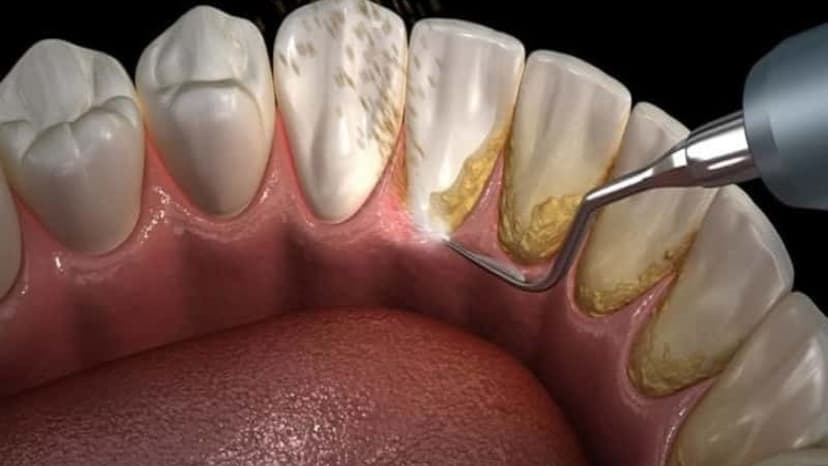 Giải đáp thắc mắc về chi phí tẩy vôi răng bao nhiêu tiền