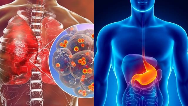 Trào ngược dạ dày gây viêm phổi: Cơ chế và cách chẩn đoán