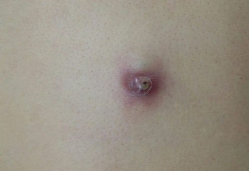 trị u bã đậu phải trị tận gốc