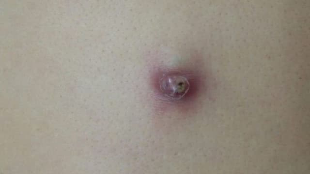 Những điều cần lưu ý khi trị u bã đậu tại nhà