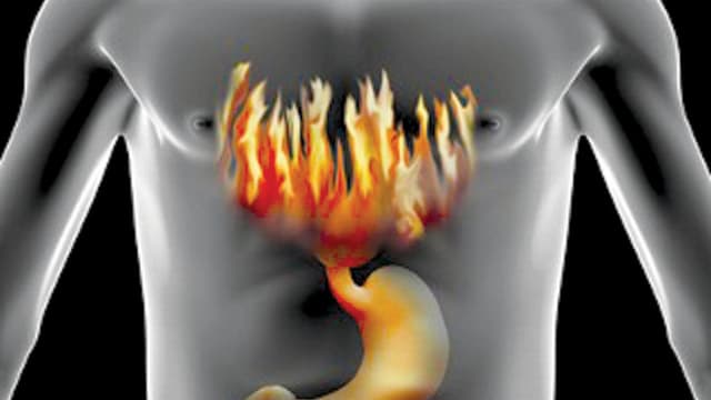 Cảnh báo bệnh lý qua triệu chứng ợ nóng