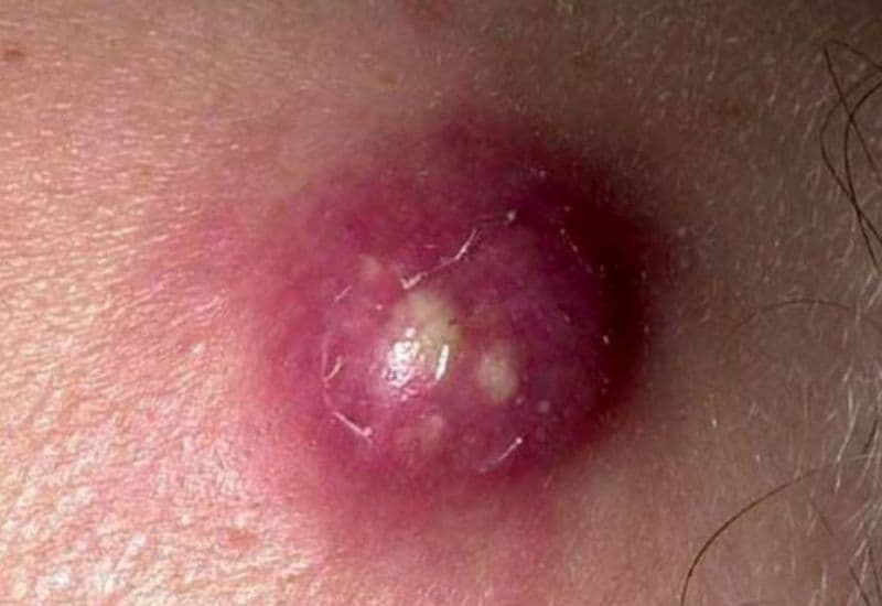 nặn mụn u bã đậu dễ gây nhiễm trùng 