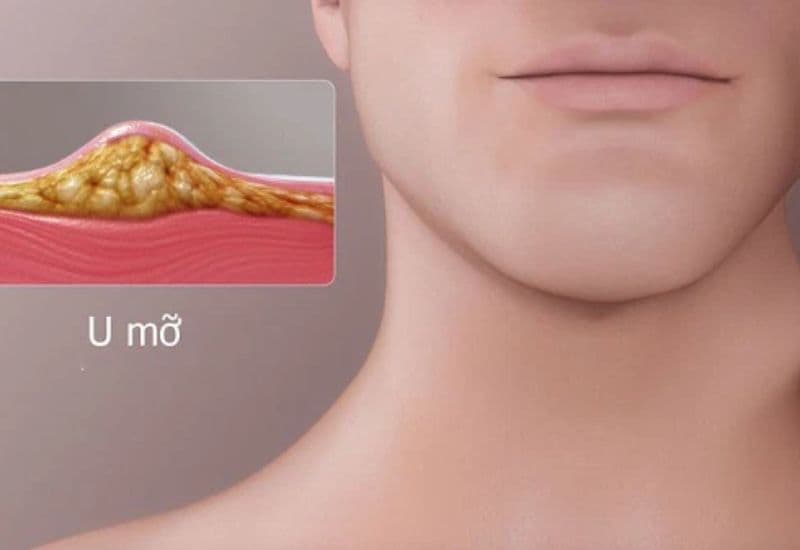 u mỡ ở cổ 