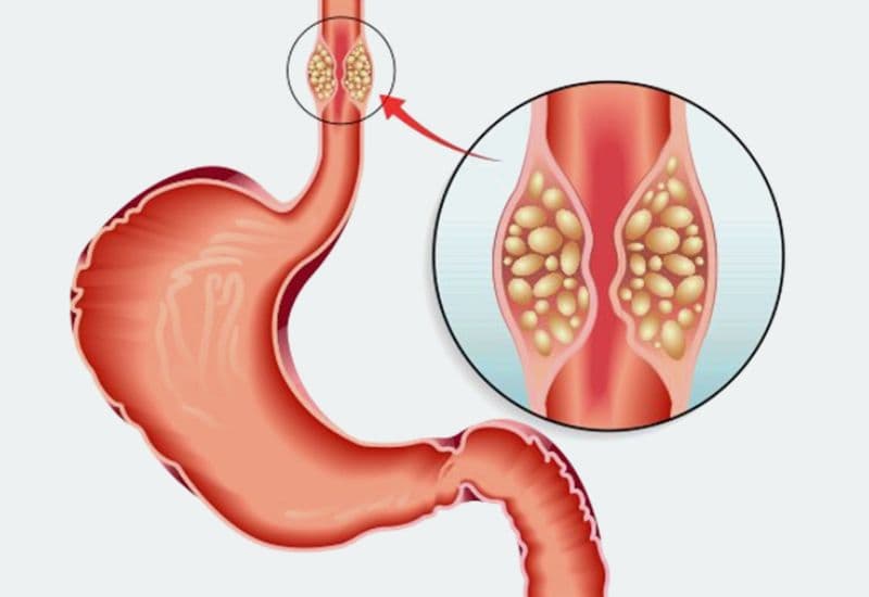 Nguyên nhân phổ biến của khó nuốt, tức ngực