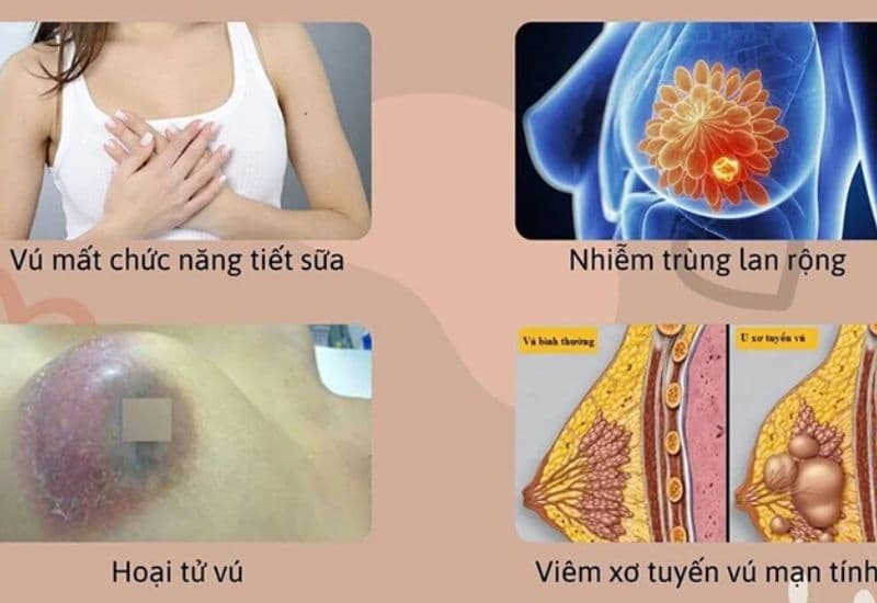 mổ áp xe ú nên thực hiện càng sớm càng tốt