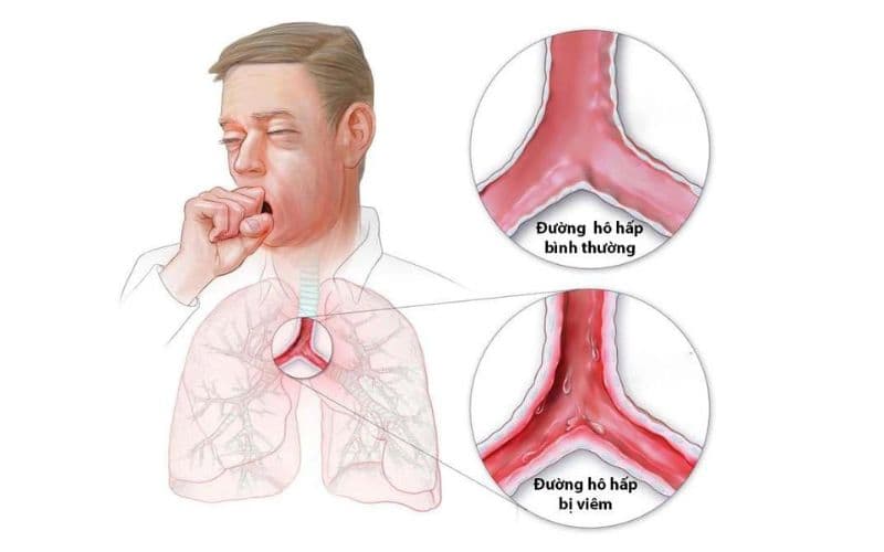 Nguyên nhân nuốt vướng 1 bên họng 