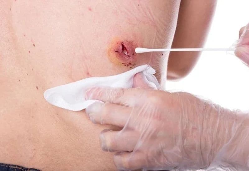 xử lý nhiễm trùng áp xe