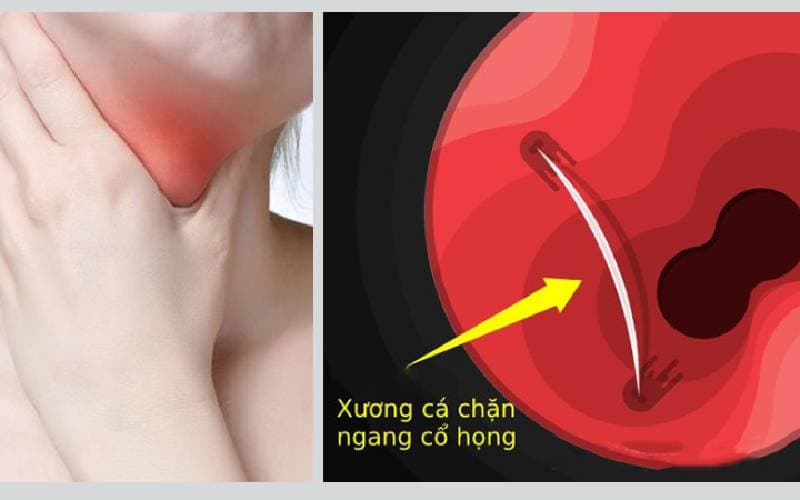 Xương cá có tự tiêu không nhỉ
