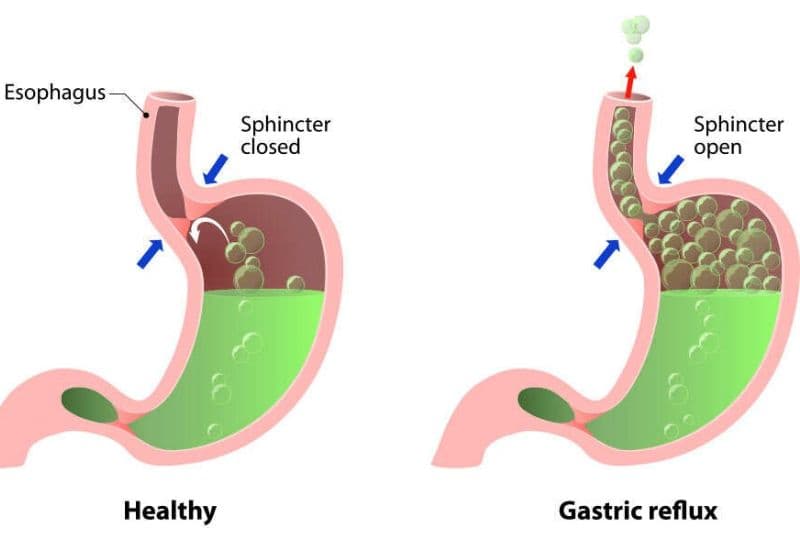 Đo áp lực thực quản - Phân biệt nguyên nhân gây ợ chua