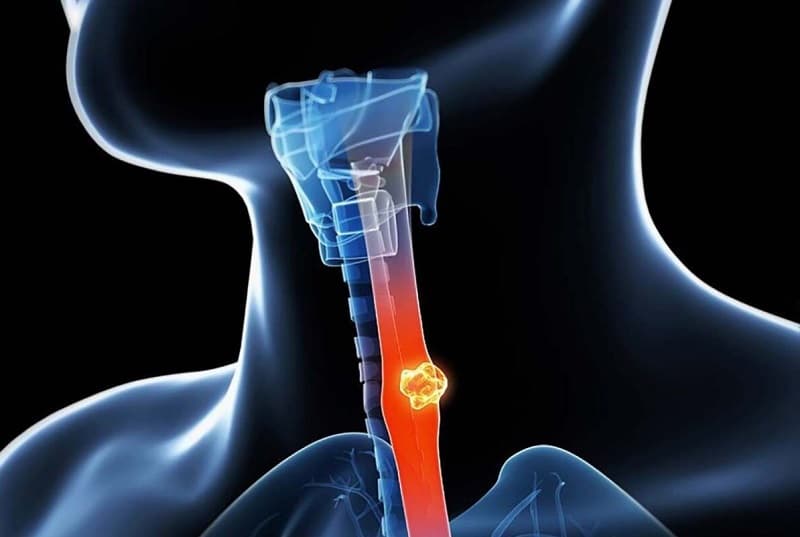 Nguyên nhân gây khó nuốt khi ăn cơm