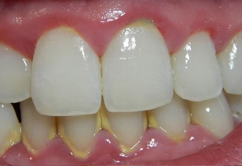 Kẽ răng là một trong những nơi khó loại bỏ cao răng nhất